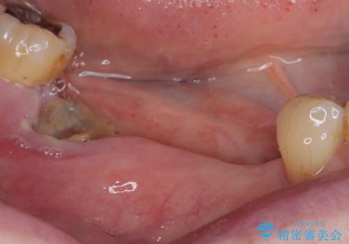 入れ歯が全く使えない 奥歯のインプラント治療の治療前