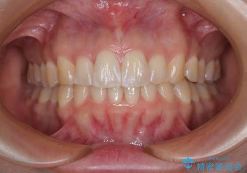 前に飛び出して目立っている前歯を整える インビザライン矯正治療の症例 治療後