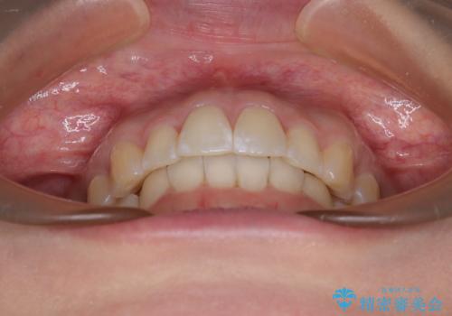 前に飛び出して目立っている前歯を整える インビザライン矯正治療の治療後