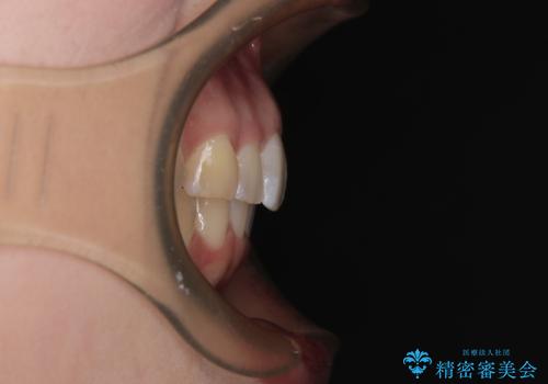 前に飛び出して目立っている前歯を整える インビザライン矯正治療の治療後