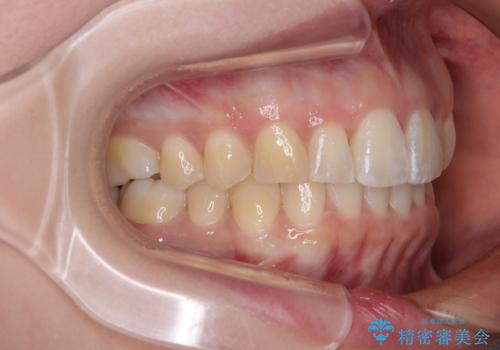 前に飛び出して目立っている前歯を整える インビザライン矯正治療の治療後