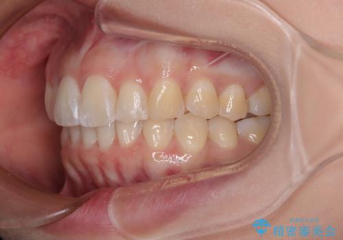 前に飛び出して目立っている前歯を整える インビザライン矯正治療の治療後