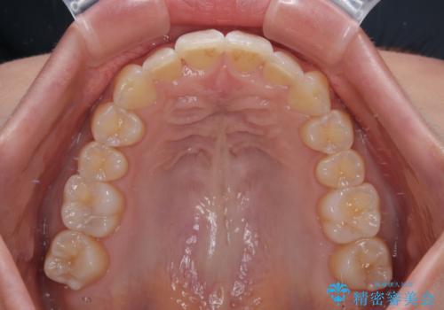 前に飛び出して目立っている前歯を整える インビザライン矯正治療の治療後