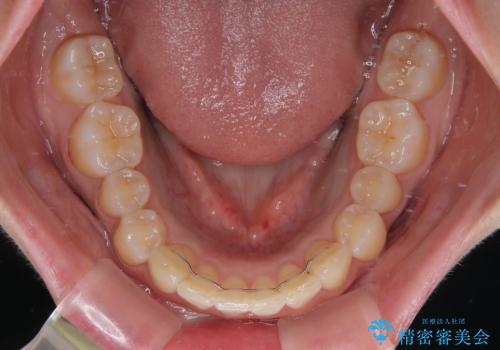 前に飛び出して目立っている前歯を整える インビザライン矯正治療の治療後