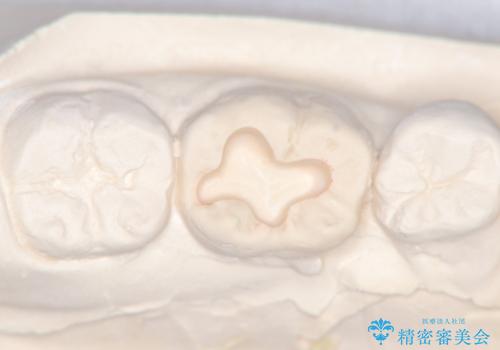 【セラミックインレー】噛む面が青白い気がするの治療中