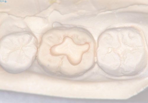 【セラミックインレー】噛む面が青白い気がするの治療中