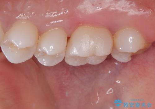 銀歯が外れてしまったのでセラミックにやり替えたい。セラミックインレー修復の治療後