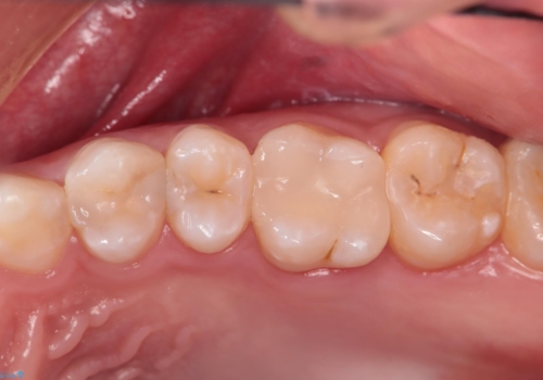 神経を守る治療 即日セラミック修復の症例 治療後