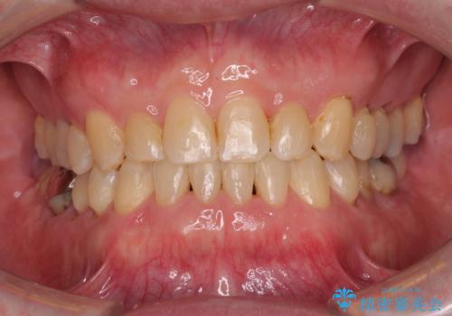 受け口を治す ワイヤー装置での矯正治療の症例 治療後
