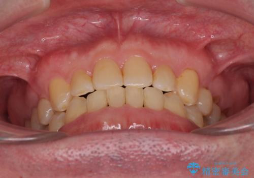 受け口を治す ワイヤー装置での矯正治療の治療後