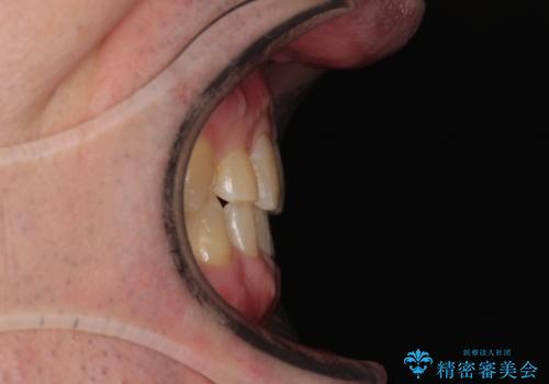 受け口を治す ワイヤー装置での矯正治療の治療後