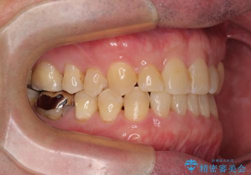 受け口を治す ワイヤー装置での矯正治療の治療後