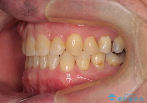 受け口を治す ワイヤー装置での矯正治療の治療後