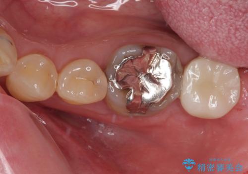 受け口を治す ワイヤー装置での矯正治療の治療後