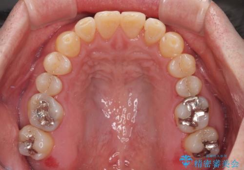 受け口を治す　ワイヤー装置での矯正治療の治療後