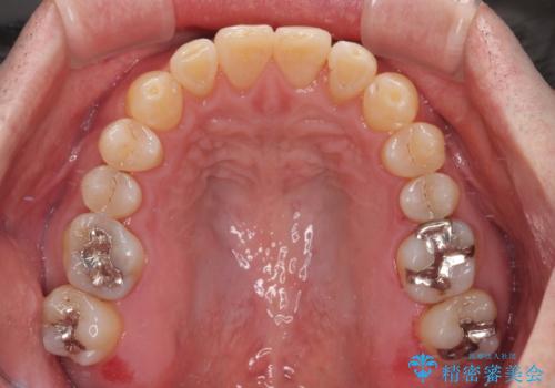 受け口を治す ワイヤー装置での矯正治療の治療後