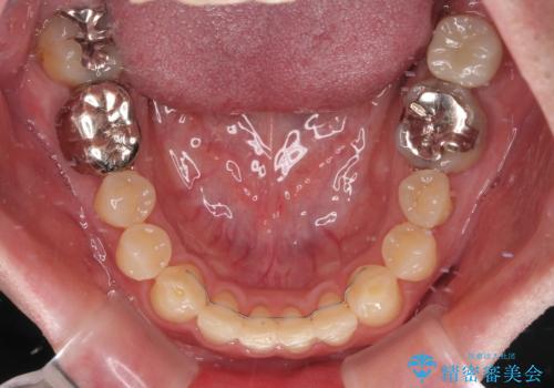 受け口を治す　ワイヤー装置での矯正治療の治療後