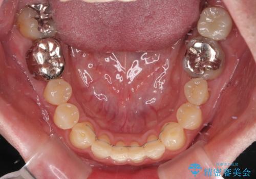 受け口を治す ワイヤー装置での矯正治療の治療後