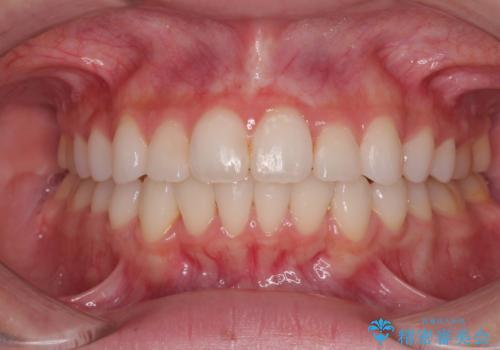 前歯のデコボコを治したい 目立たないワイヤー装置での矯正治療の症例 治療後