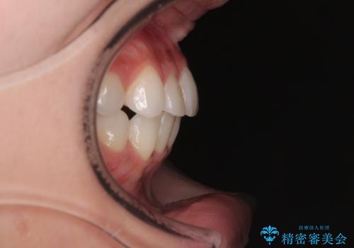 前歯のデコボコを治したい 目立たないワイヤー装置での矯正治療の治療後