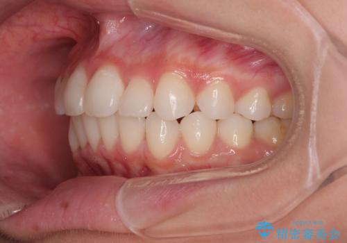 前歯のデコボコを治したい 目立たないワイヤー装置での矯正治療の治療後