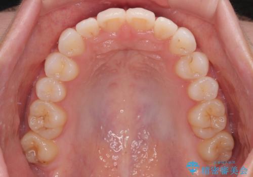 前歯のデコボコを治したい 目立たないワイヤー装置での矯正治療の治療後