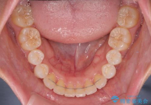 前歯のデコボコを治したい 目立たないワイヤー装置での矯正治療の治療後