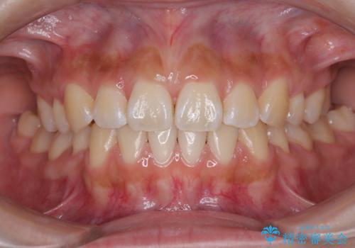 飛べ出ている出っ歯を治したい　目立たない装置での抜歯矯正治療の治療後
