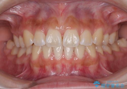 飛び出ている出っ歯を治したい 目立たない装置での抜歯矯正治療の症例 治療後