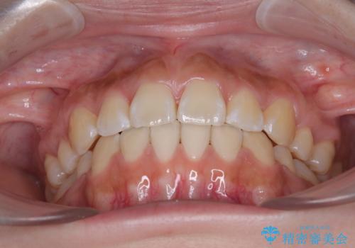 飛び出ている出っ歯を治したい 目立たない装置での抜歯矯正治療の治療後