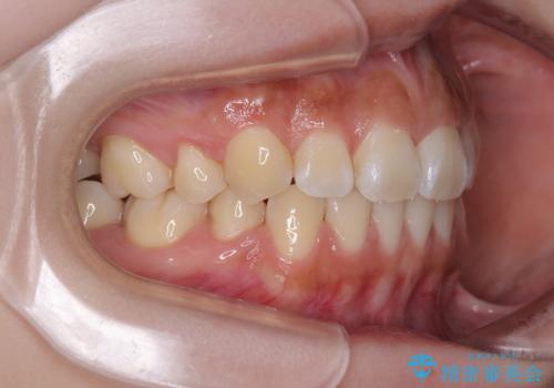 飛び出ている出っ歯を治したい 目立たない装置での抜歯矯正治療の治療後