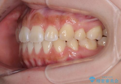 飛び出ている出っ歯を治したい 目立たない装置での抜歯矯正治療の治療後