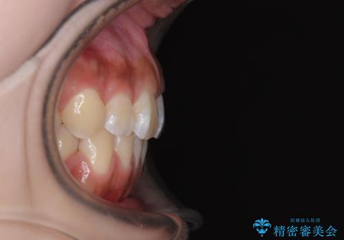 飛び出ている出っ歯を治したい 目立たない装置での抜歯矯正治療の治療後