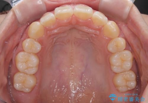 飛べ出ている出っ歯を治したい　目立たない装置での抜歯矯正治療の治療後