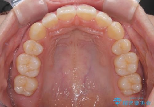 飛び出ている出っ歯を治したい 目立たない装置での抜歯矯正治療の治療後