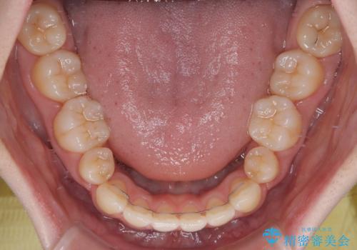 飛び出ている出っ歯を治したい 目立たない装置での抜歯矯正治療の治療後