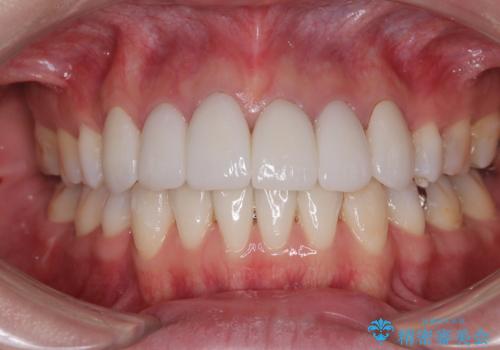 気になる八重歯と変色した前歯 抜歯矯正とセラミッククラウン治療の症例 治療後