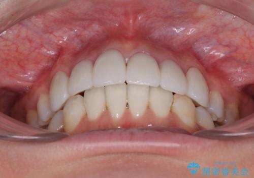 気になる八重歯と変色した前歯 抜歯矯正とセラミッククラウン治療の治療後