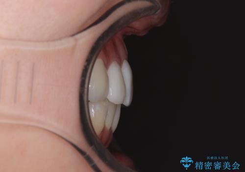 気になる八重歯と変色した前歯 抜歯矯正とセラミッククラウン治療の治療後