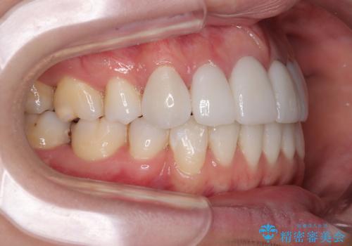 気になる八重歯と変色した前歯 抜歯矯正とセラミッククラウン治療の治療後