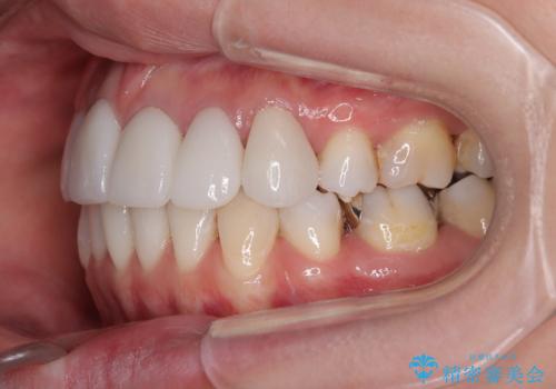 気になる八重歯と変色した前歯 抜歯矯正とセラミッククラウン治療の治療後