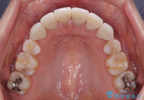 気になる八重歯と変色した前歯　抜歯矯正とセラミッククラウン治療の治療後