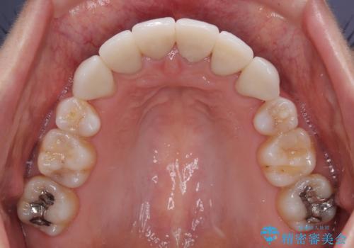 気になる八重歯と変色した前歯 抜歯矯正とセラミッククラウン治療の治療後