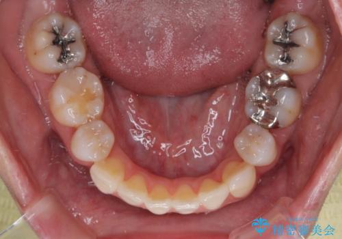 気になる八重歯と変色した前歯 抜歯矯正とセラミッククラウン治療の治療後