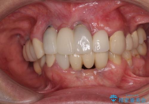 1DAYインプラント 土台から外れてしまった前歯を短期間で治療の治療後