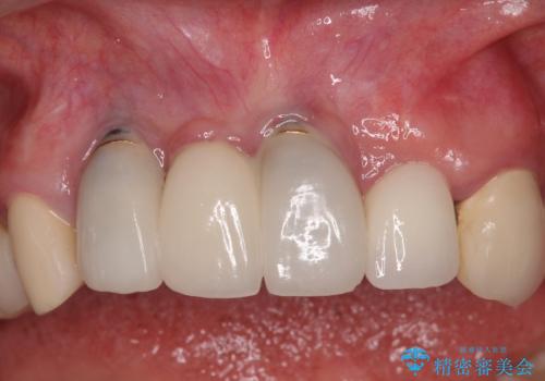 1DAYインプラント 土台から外れてしまった前歯を短期間で治療の症例 治療後