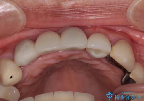 1DAYインプラント 土台から外れてしまった前歯を短期間で治療の治療後