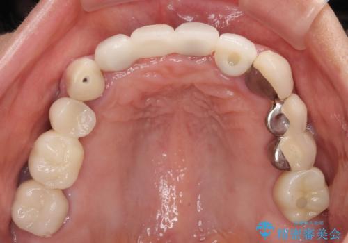 1DAYインプラント 土台から外れてしまった前歯を短期間で治療の治療後