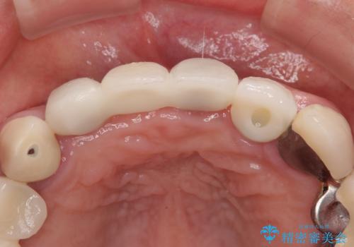 1DAYインプラント 土台から外れてしまった前歯を短期間で治療の治療後