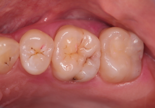 虫歯の再発　セラミックインレーにて治療